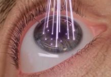 Lasik nove generacije